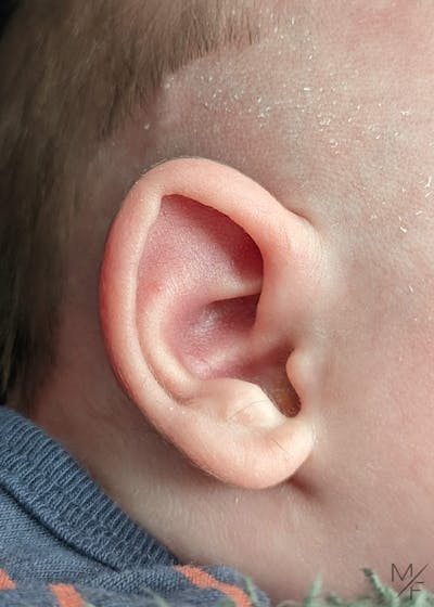 Ear Molding Before & After Gallery - Patient 143805169 - Image 1
