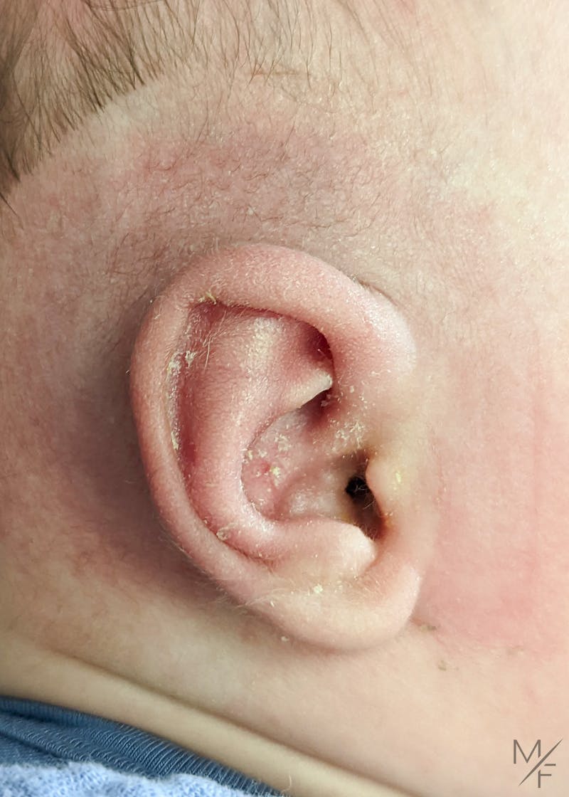 Ear Molding Before & After Gallery - Patient 143805169 - Image 2
