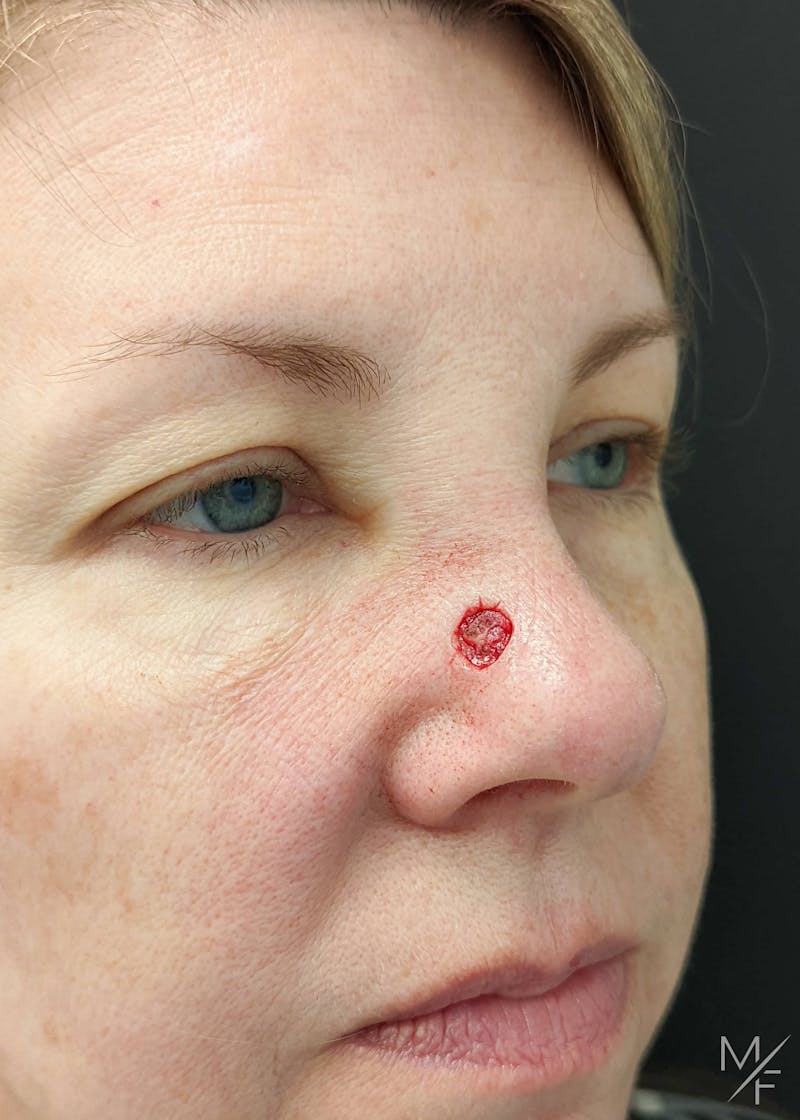Skin Cancer Reconstruction Before & After Gallery - Patient 144151666 - Image 1