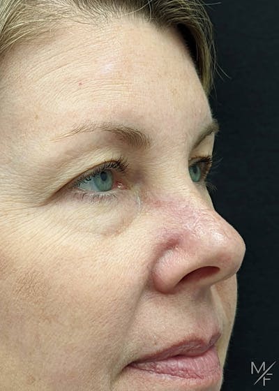 Skin Cancer Reconstruction Before & After Gallery - Patient 144151666 - Image 2