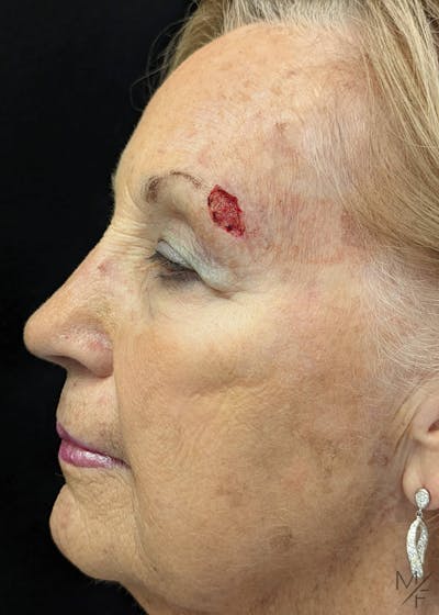 Skin Cancer Reconstruction Before & After Gallery - Patient 144151667 - Image 1