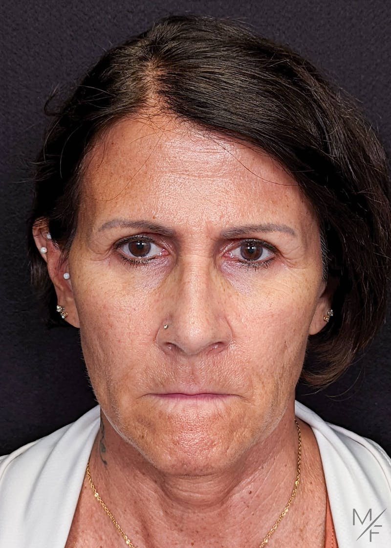 Browlift Before & After Gallery - Patient 144151679 - Image 1