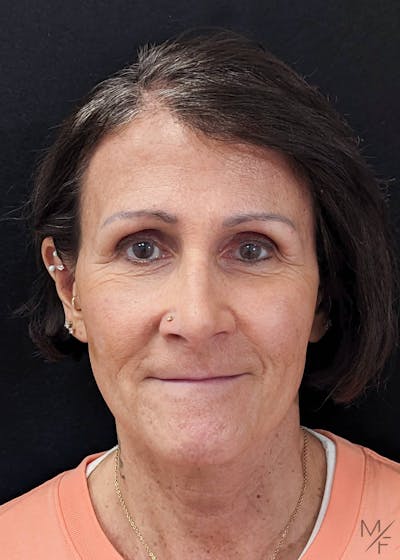 Browlift Before & After Gallery - Patient 144151679 - Image 2