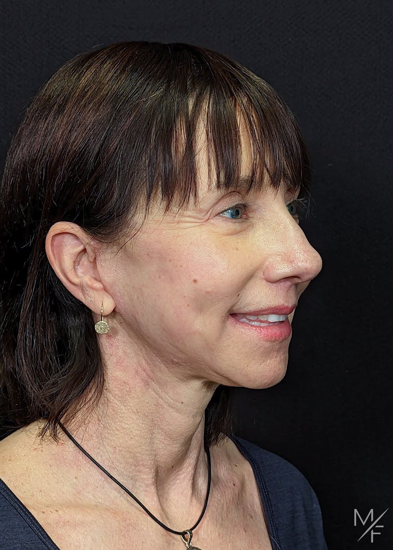 Facelift Before & After Gallery - Patient 145833671 - Image 4