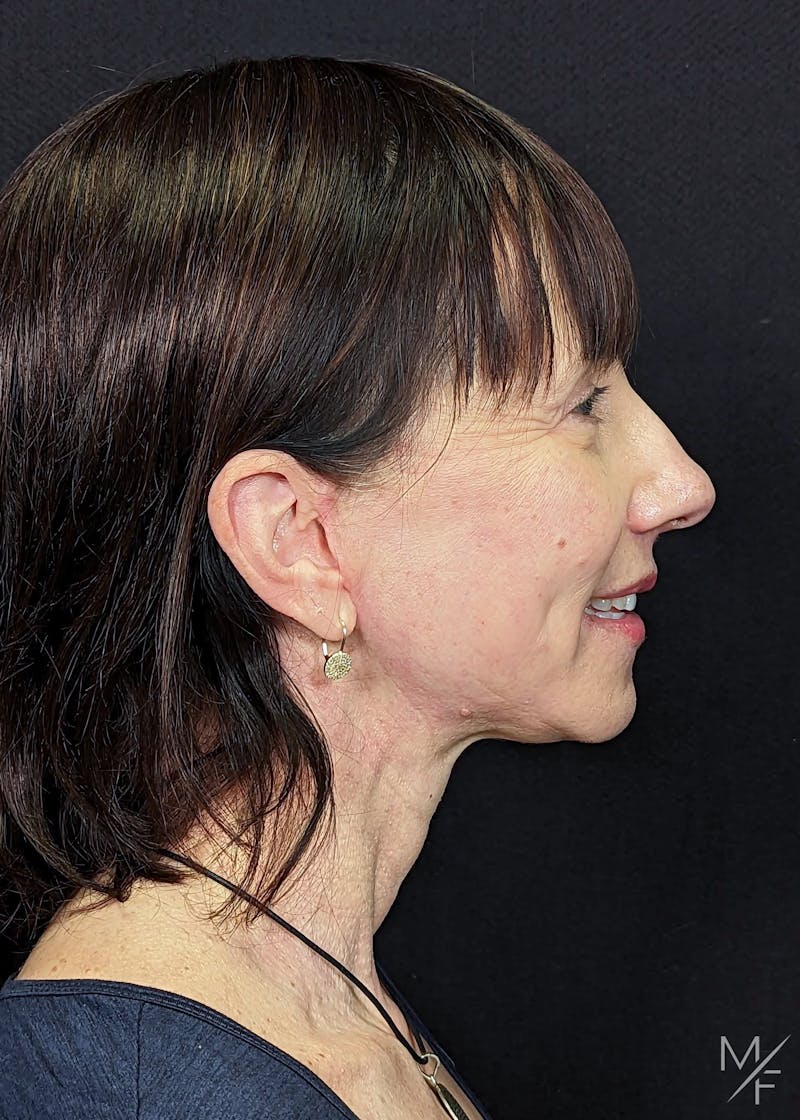 Facelift Before & After Gallery - Patient 145833671 - Image 6
