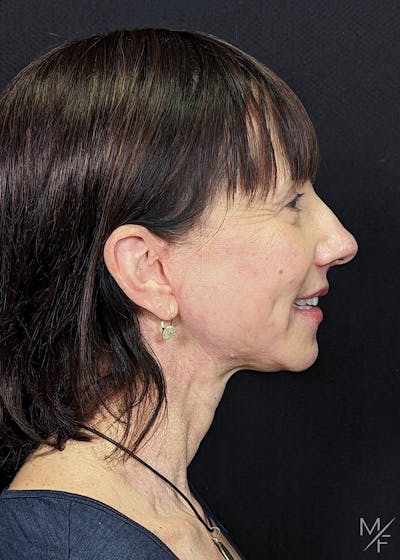 Neck Lift Before & After Gallery - Patient 371481 - Image 2