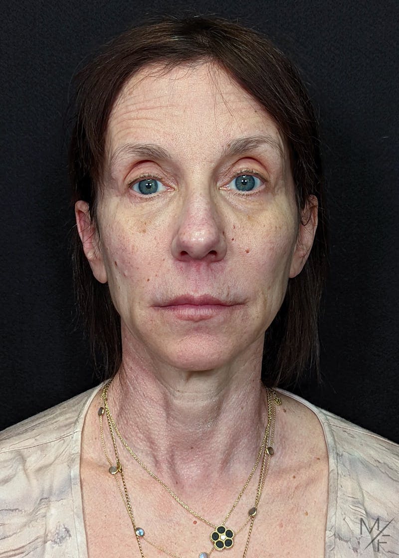 Facelift Before & After Gallery - Patient 145833671 - Image 1