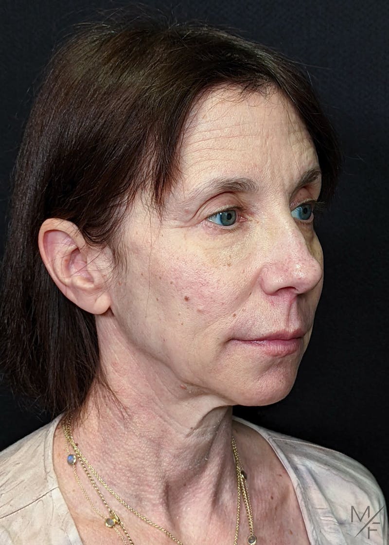 Facelift Before & After Gallery - Patient 145833671 - Image 3