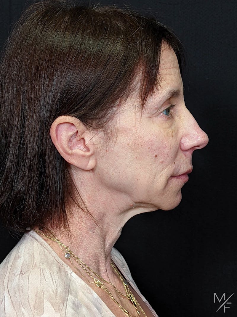 Facelift Before & After Gallery - Patient 145833671 - Image 5