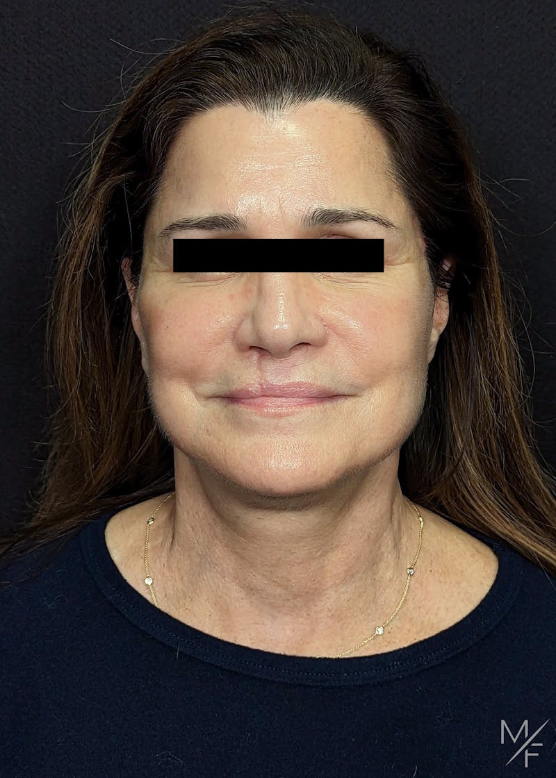 Neck Lift Before & After Gallery - Patient 223818 - Image 6