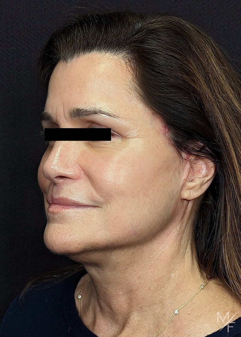 Facelift Before & After Gallery - Patient 145833683 - Image 4