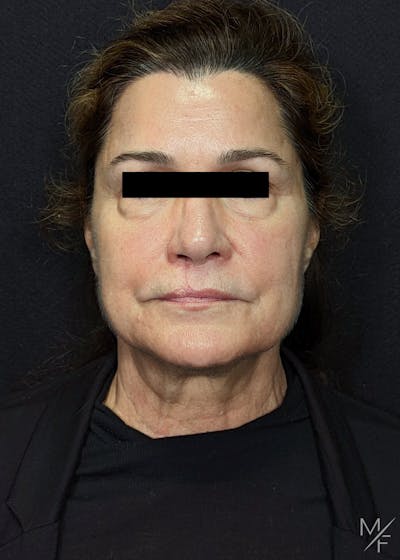 Facelift Before & After Gallery - Patient 145833683 - Image 1