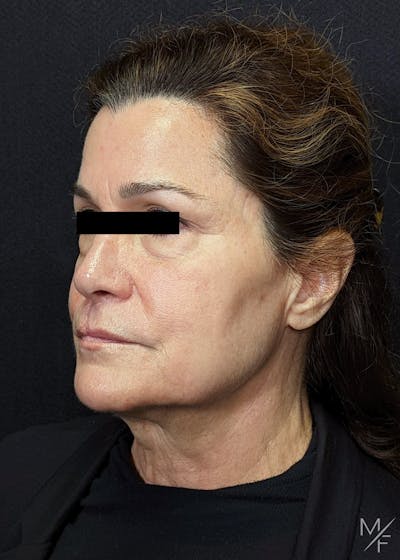 Facelift Before & After Gallery - Patient 145833683 - Image 1