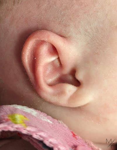 Ear Molding Before & After Gallery - Patient 145833694 - Image 2