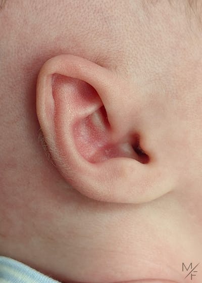 Ear Molding Before & After Gallery - Patient 145833694 - Image 1