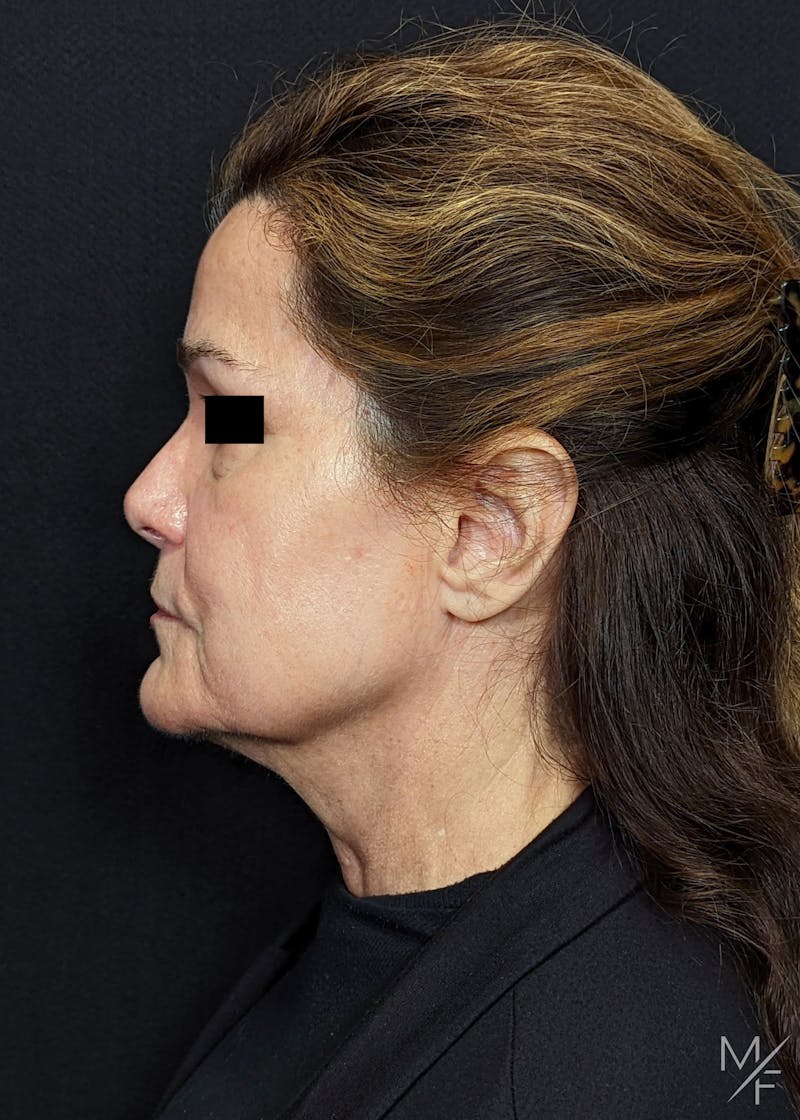 Neck Lift Before & After Gallery - Patient 223818 - Image 1