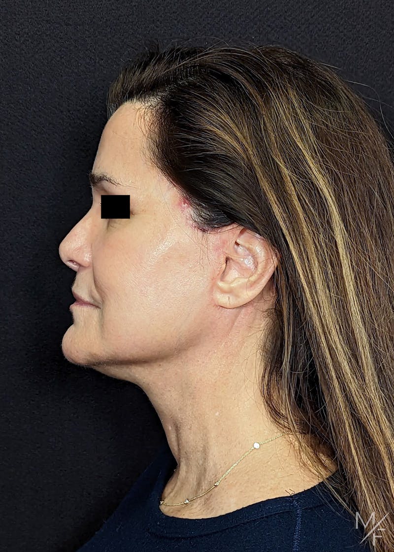 Facelift Before & After Gallery - Patient 145833683 - Image 6