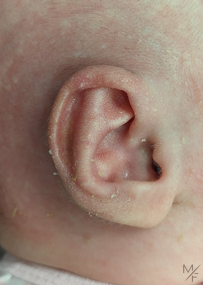Ear Molding Before & After Gallery - Patient 146343208 - Image 2