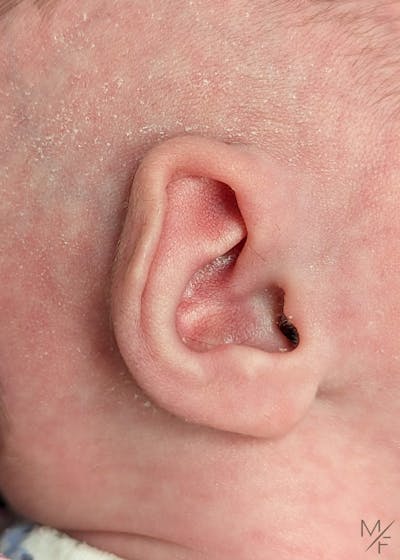 Ear Molding Before & After Gallery - Patient 146343208 - Image 1