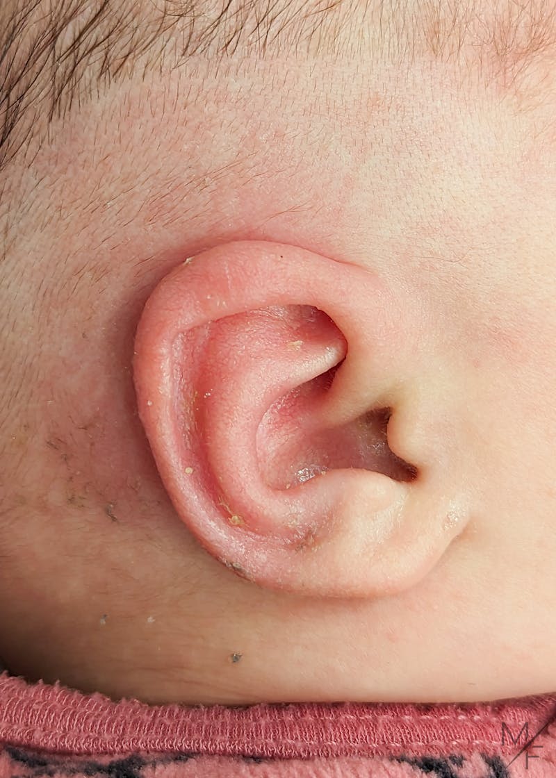 Ear Molding Before & After Gallery - Patient 146343260 - Image 2