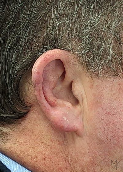 Skin Cancer Reconstruction Before & After Gallery - Patient 146343312 - Image 2