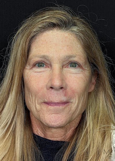 Blepharoplasty Before & After Gallery - Patient 146898742 - Image 2
