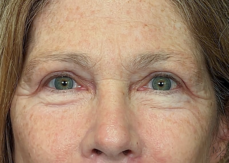 Blepharoplasty Before & After Gallery - Patient 146898742 - Image 4