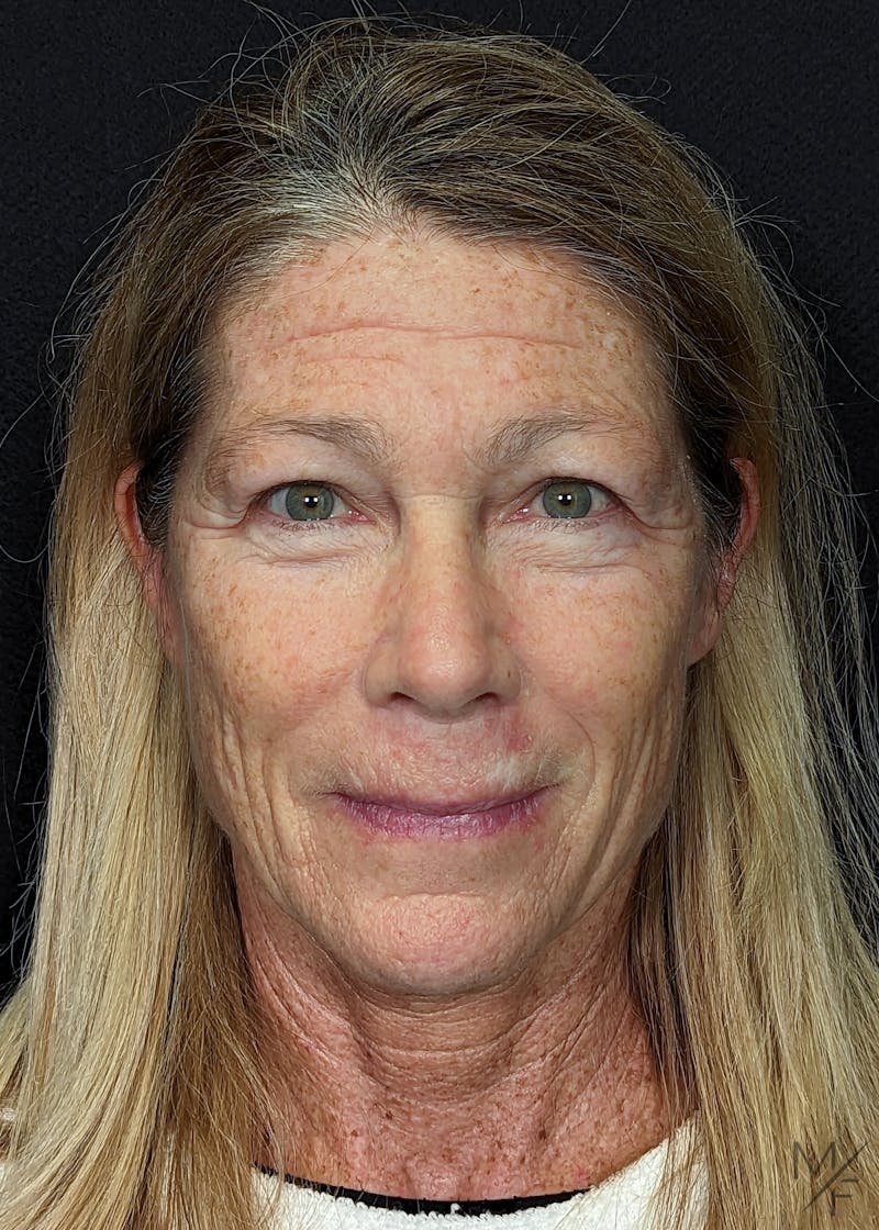 Blepharoplasty Before & After Gallery - Patient 146898742 - Image 1