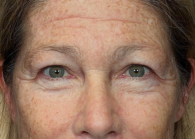 Blepharoplasty Before & After Gallery - Patient 146898742 - Image 3