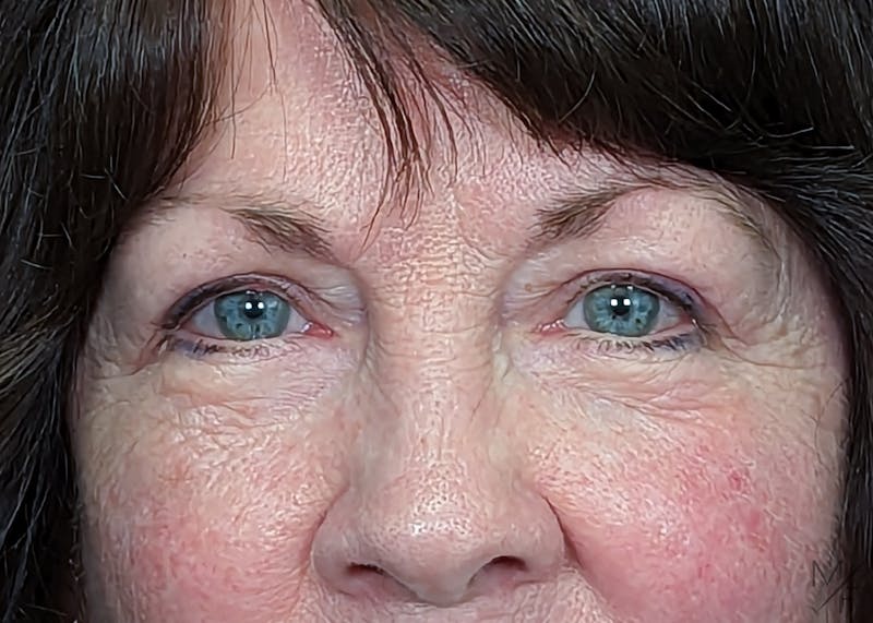 Blepharoplasty Before & After Gallery - Patient 147062615 - Image 2