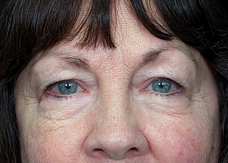 Blepharoplasty Before & After Gallery - Patient 147062615 - Image 1