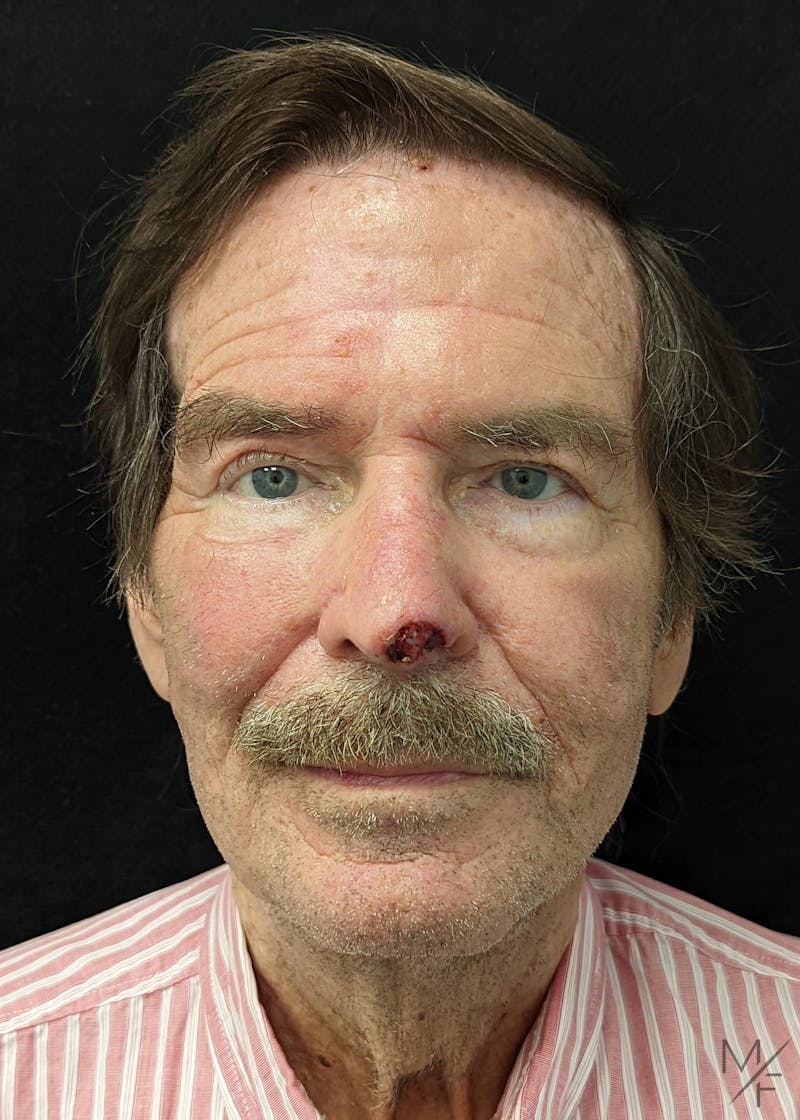 Skin Cancer Reconstruction Before & After Gallery - Patient 147062634 - Image 3