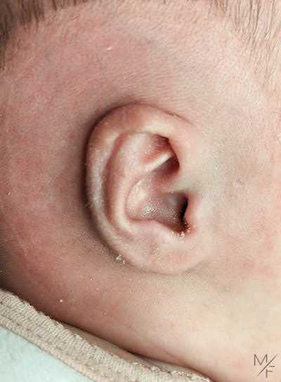 Ear Molding Before & After Gallery - Patient 147645323 - Image 2