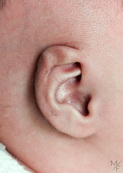 Ear Molding Before & After Gallery - Patient 147645323 - Image 1
