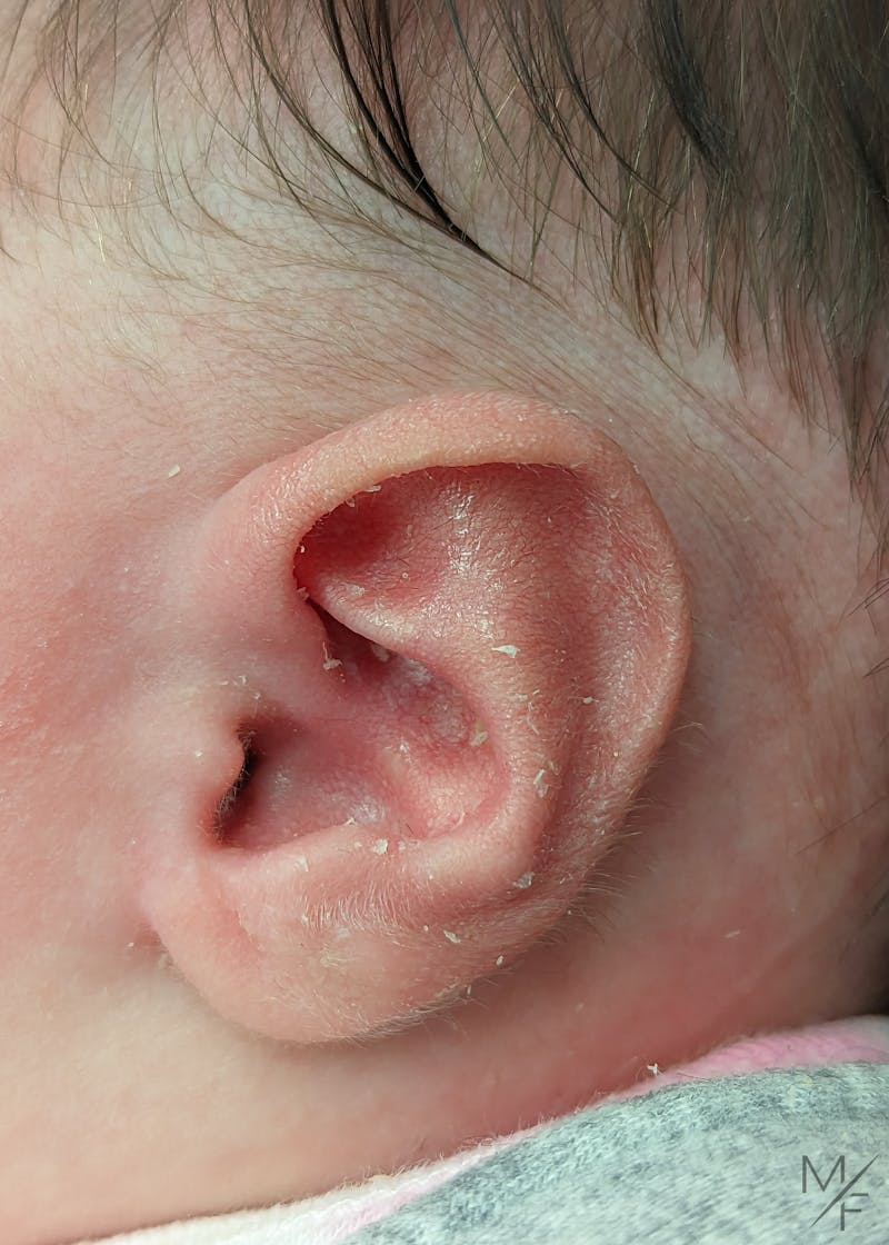 Ear Molding Before & After Gallery - Patient 147645322 - Image 2