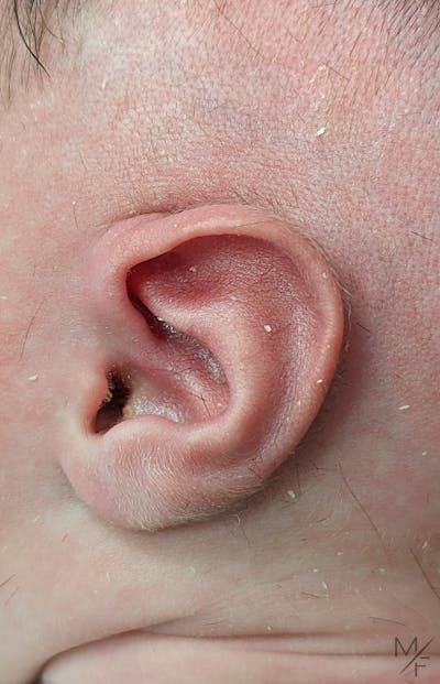 Ear Molding Before & After Gallery - Patient 147645322 - Image 1