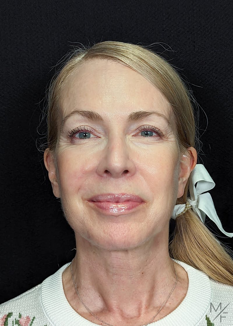 Neck Lift Before & After Gallery - Patient 269682 - Image 6