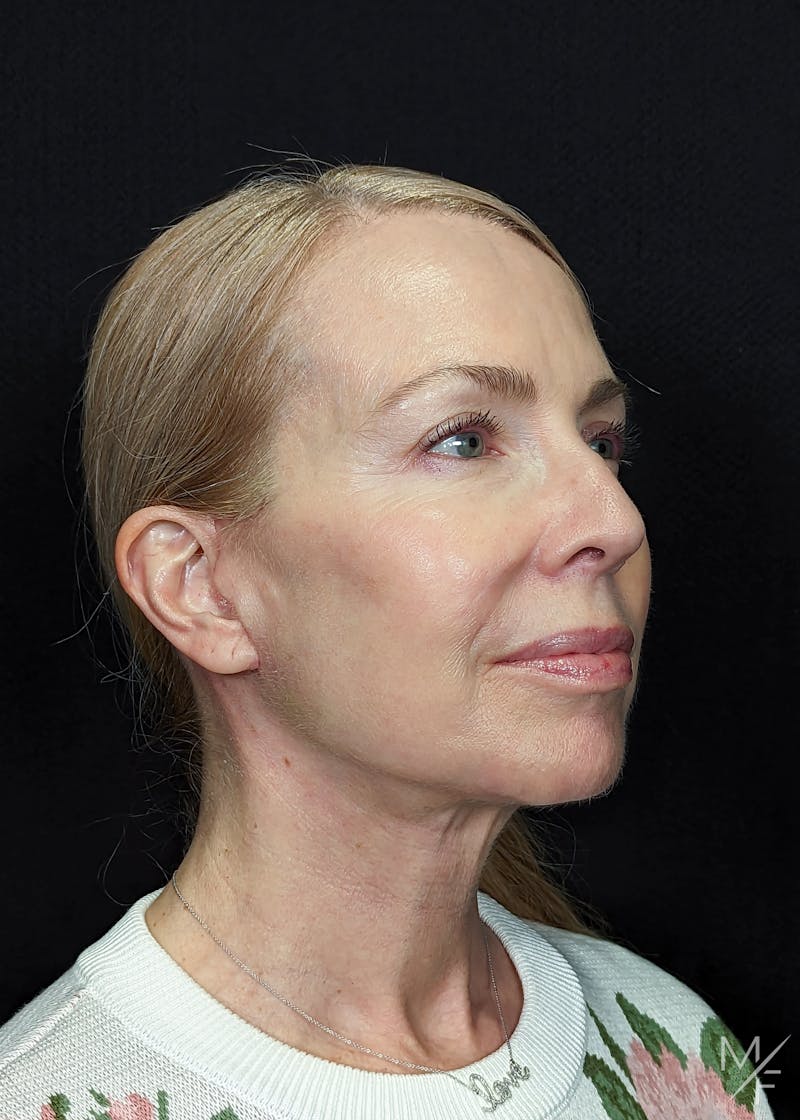 Neck Lift Before & After Gallery - Patient 269682 - Image 4