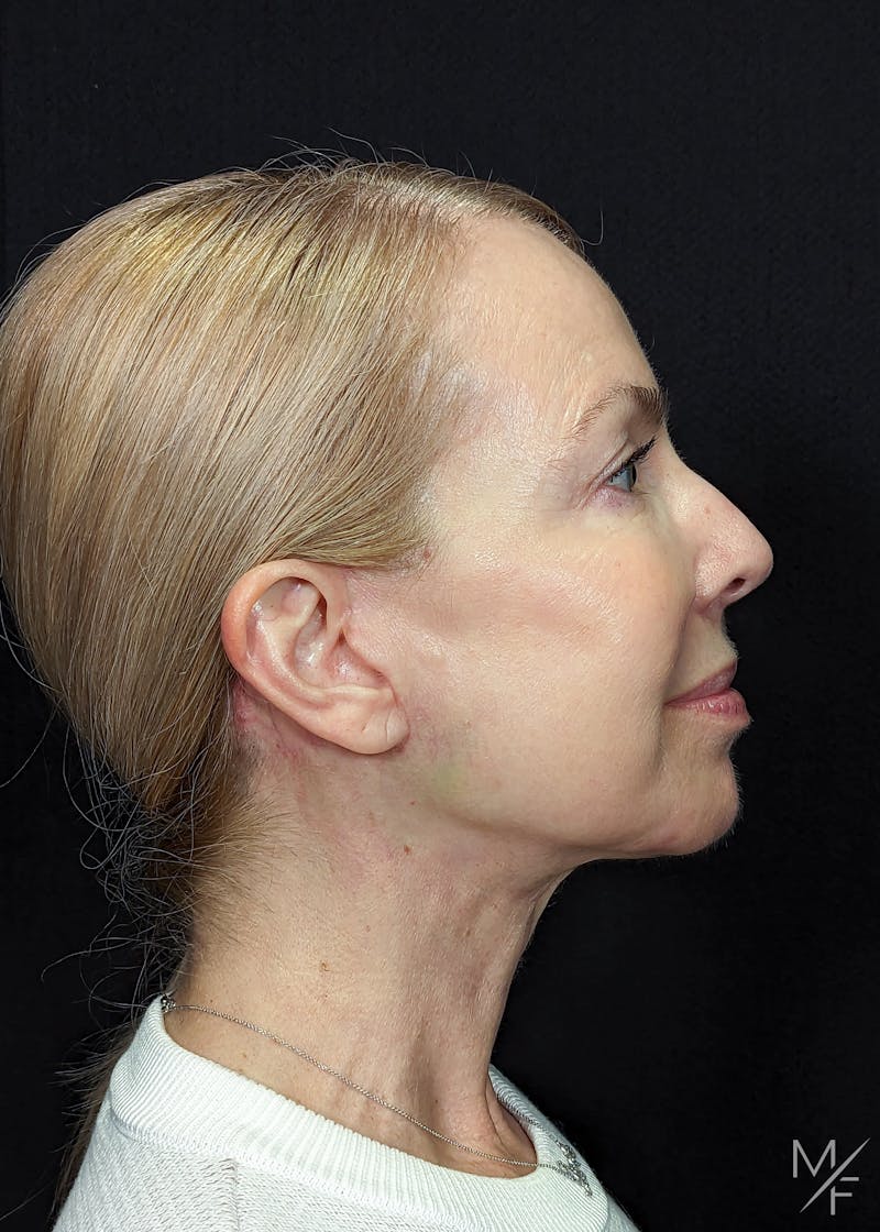 Neck Lift Before & After Gallery - Patient 269682 - Image 2