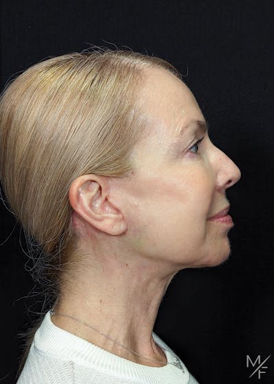 Neck Lift Before & After Gallery - Patient 269682 - Image 2