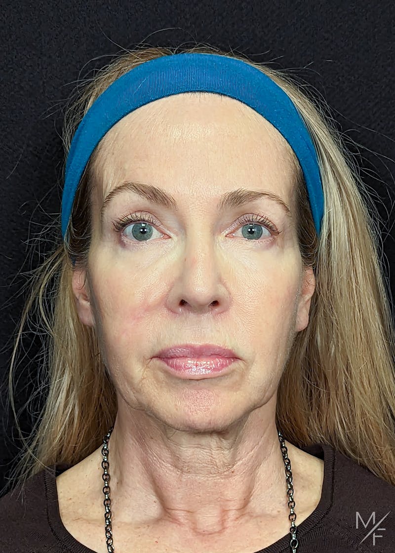 Facelift Before & After Gallery - Patient 147645326 - Image 1