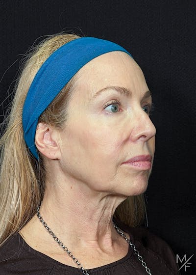 Facelift Before & After Gallery - Patient 147645326 - Image 1