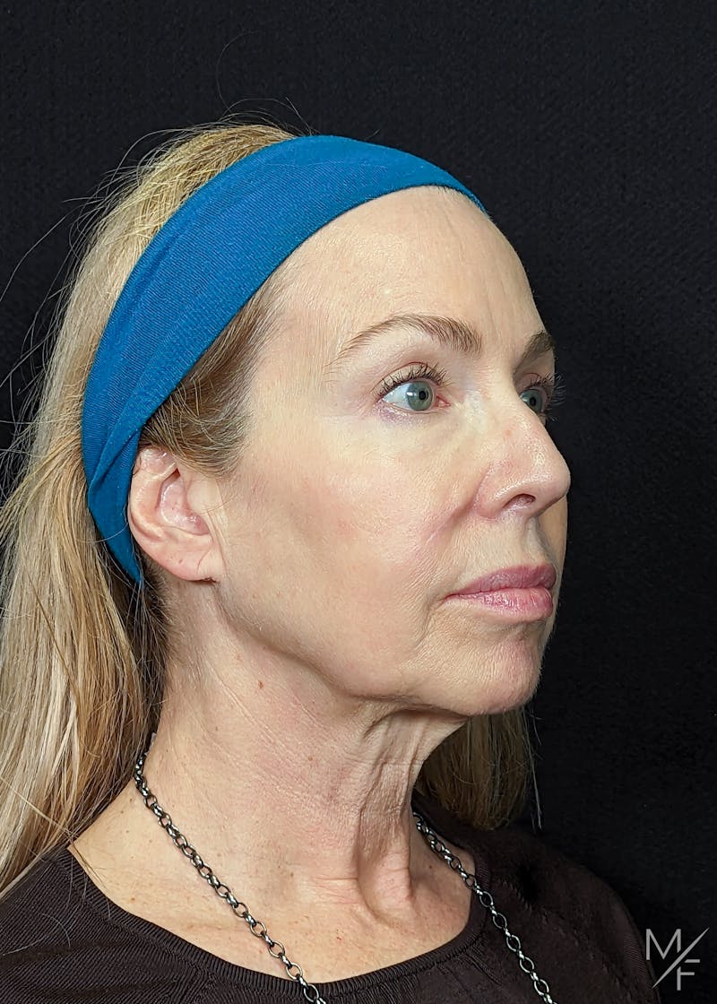 Facelift Before & After Gallery - Patient 147645326 - Image 3
