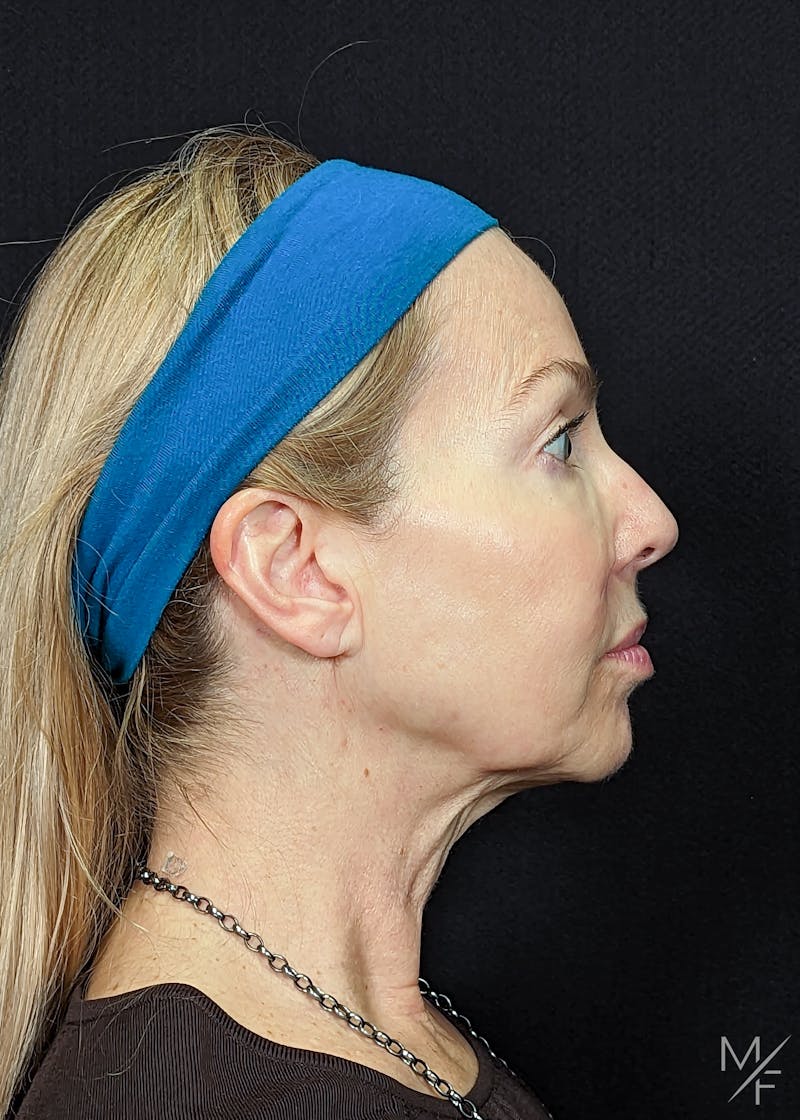 Neck Lift Before & After Gallery - Patient 269682 - Image 1