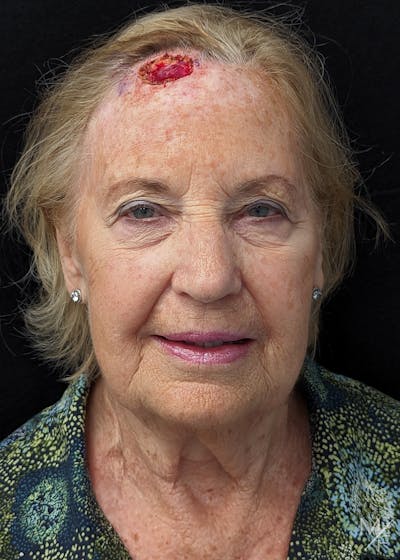 Skin Cancer Reconstruction Before & After Gallery - Patient 148648219 - Image 1