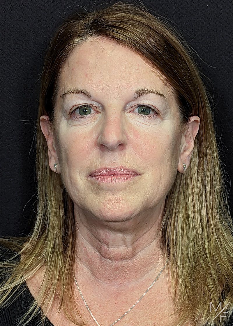 Neck Lift Before & After Gallery - Patient 105204 - Image 5