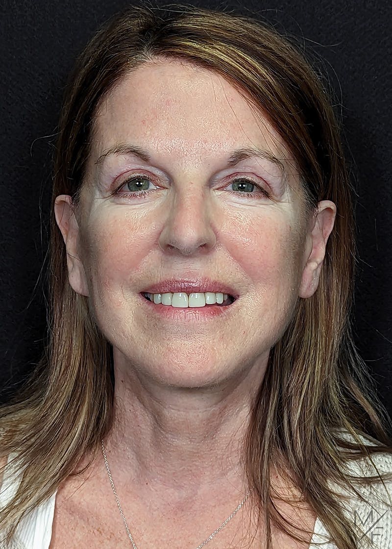 Facelift Before & After Gallery - Patient 148864625 - Image 2