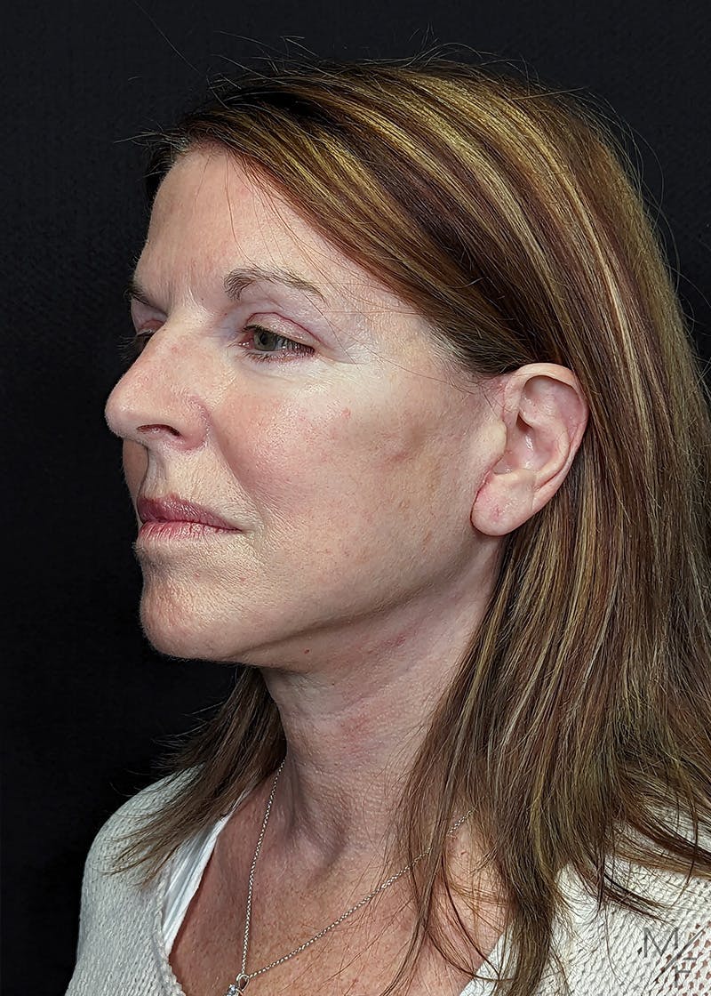 Facelift Before & After Gallery - Patient 148864625 - Image 4