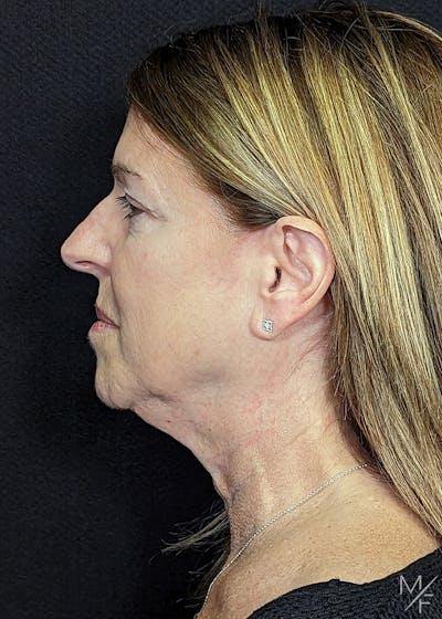 Neck Lift Before & After Gallery - Patient 105204 - Image 1