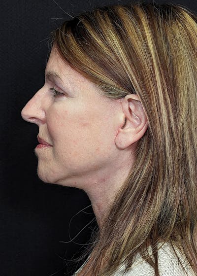 Neck Lift Before & After Gallery - Patient 105204 - Image 2